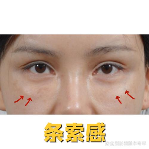 玻尿酸填充眼窝安全吗