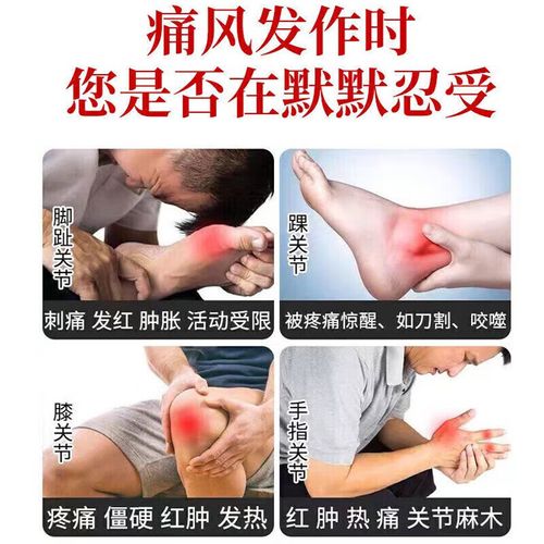 十味乳香丸能治痛风吗