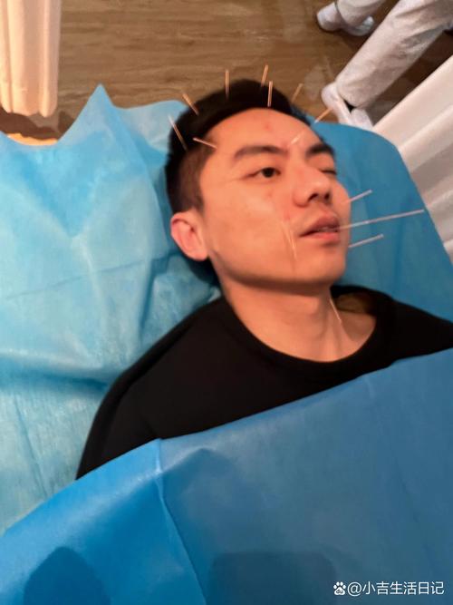 急性面瘫可以针灸吗