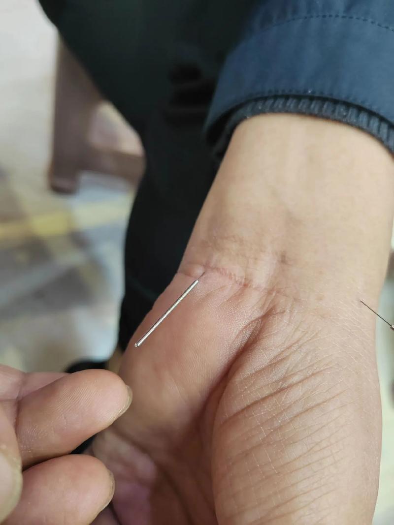 杭州中医针灸哪里好