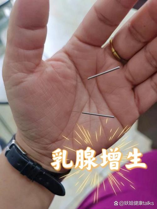 乳腺增生针灸扎手指