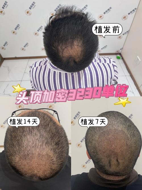 毛发移植海峡植发安全