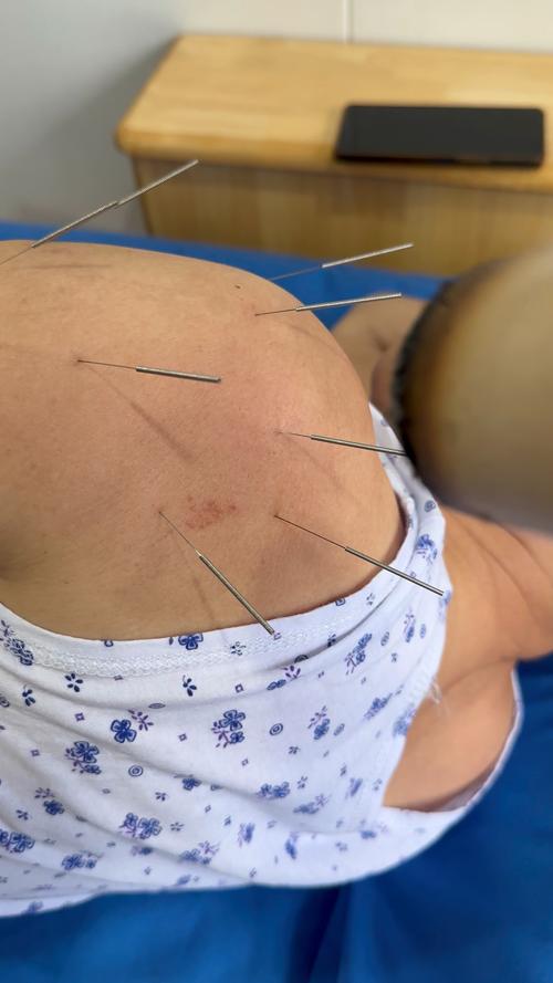 中医针灸颈肩腰腿痛