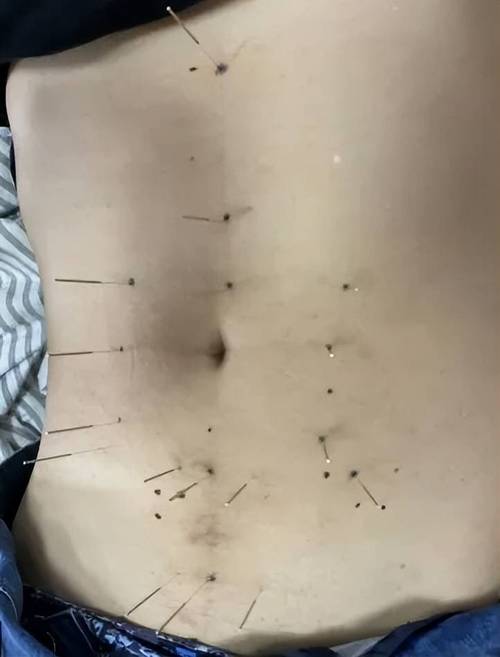 针灸腹部减肥有效吗