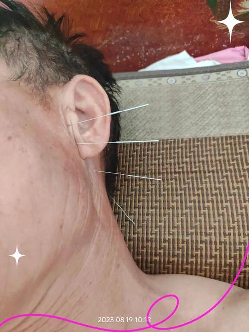 耳鸣针灸治疗穴位图