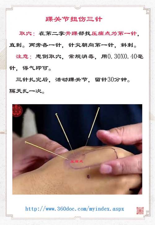 脚踝韧带损伤针灸吗