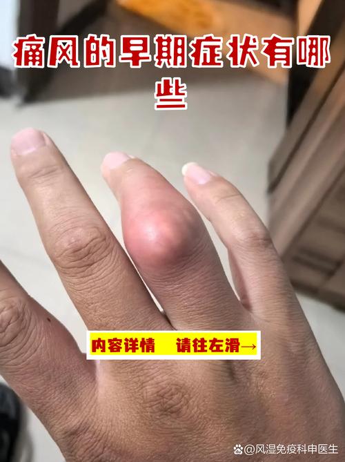 痛风的前期症状是什么