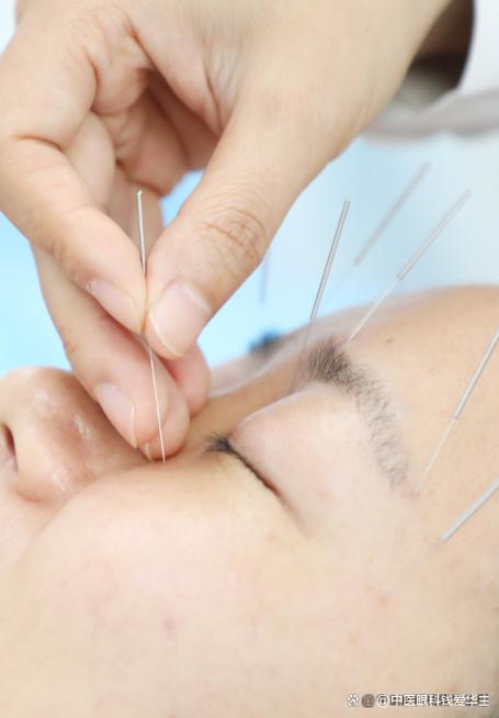 开封针灸面部哪里好