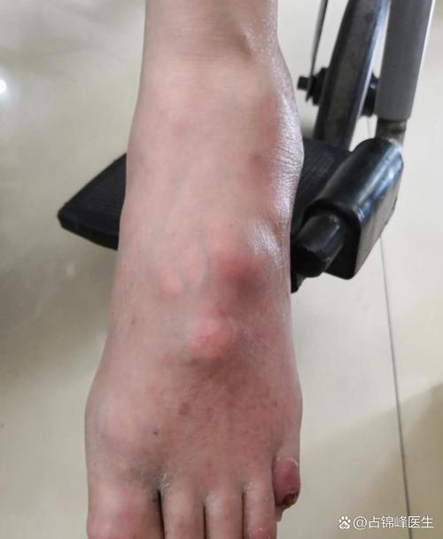 痛风的初期症状有哪些