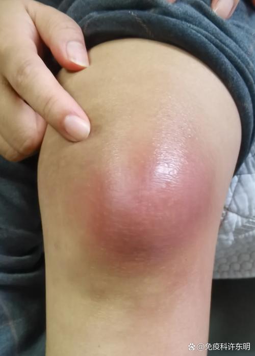 痛风的初期症状有哪些