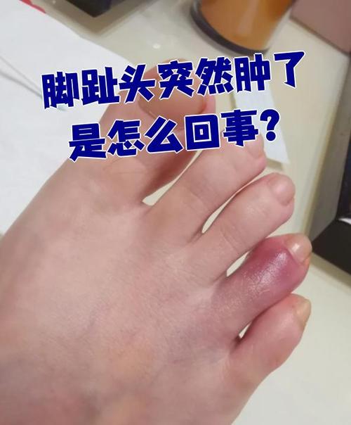 痛风脚趾头肿了怎么办