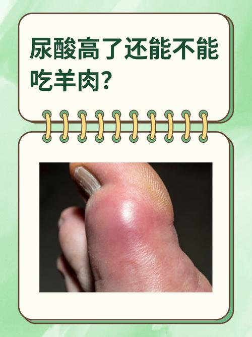 痛风病人可以吃羊肉吗