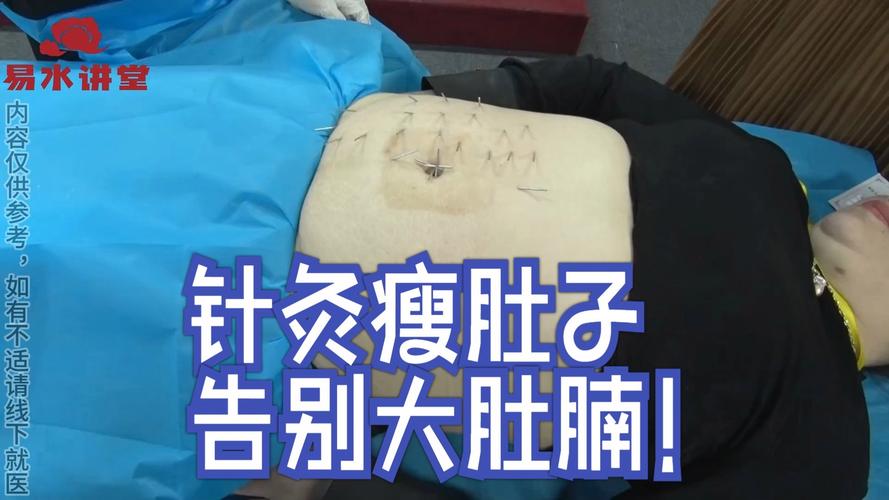 针灸肚子减肥有效吗