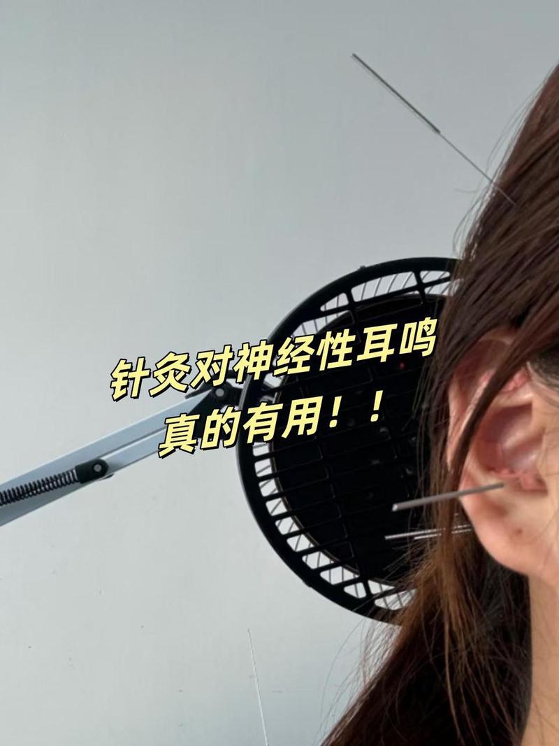 神经耳鸣针灸能好吗