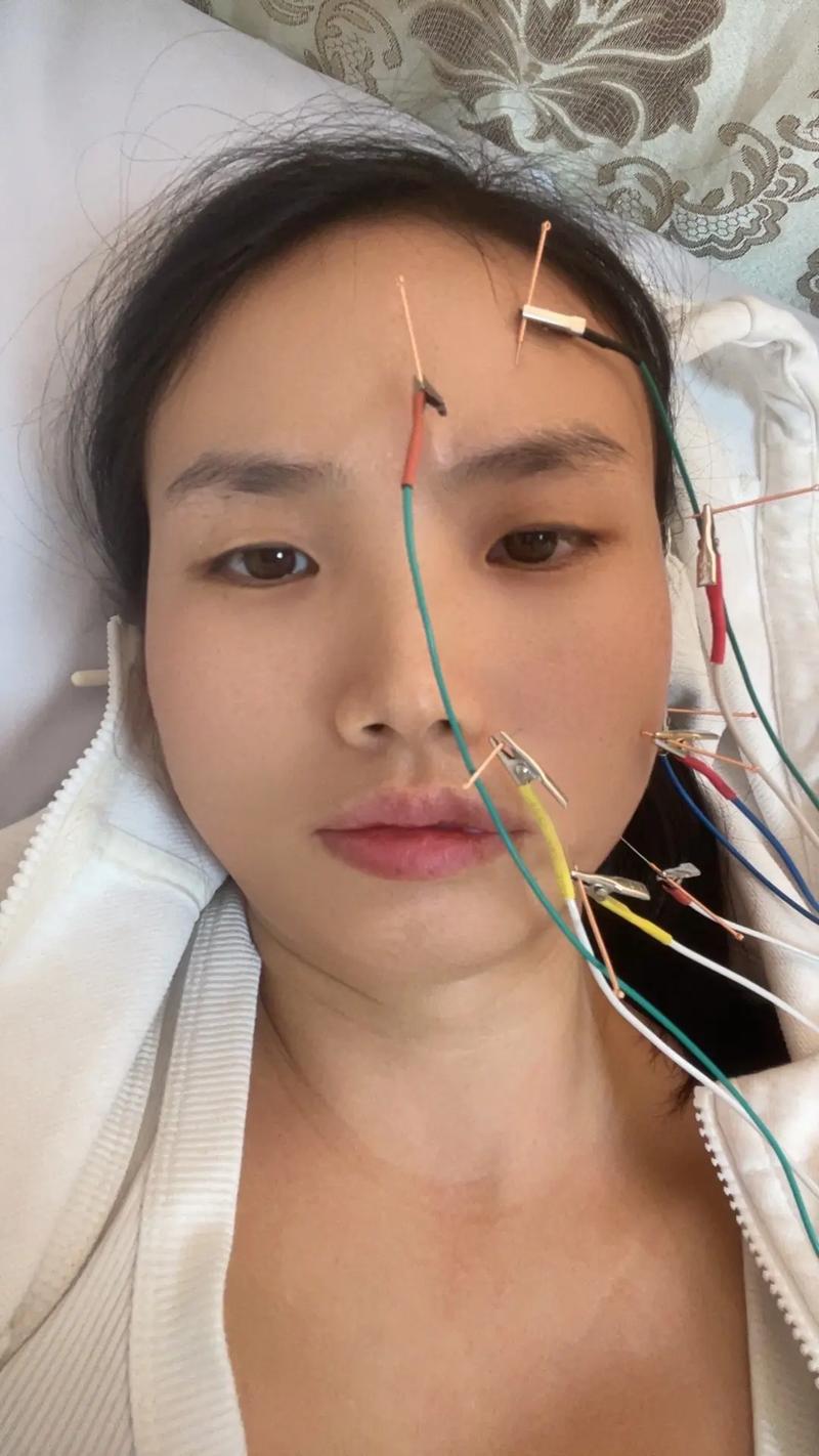 面瘫用电针还是针灸