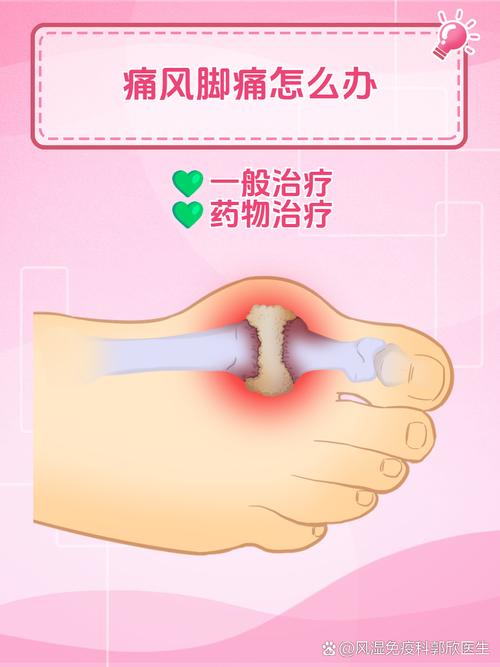 痛风脚疼的厉害怎么办