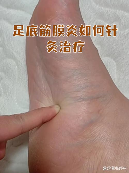 肌筋膜针灸技术视频