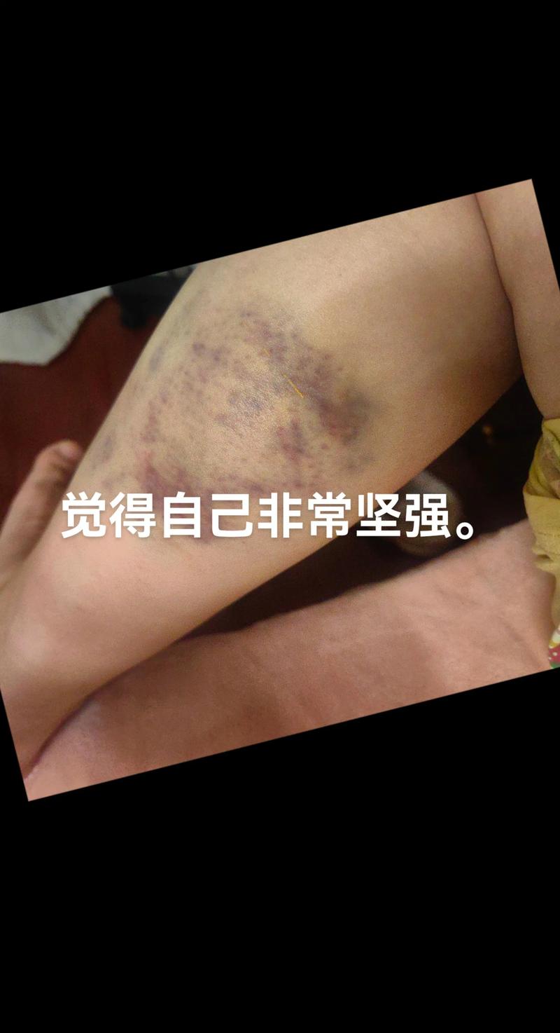 痛风伤口不愈合怎么办