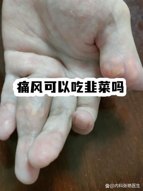 痛风患者可以吃韭菜吗
