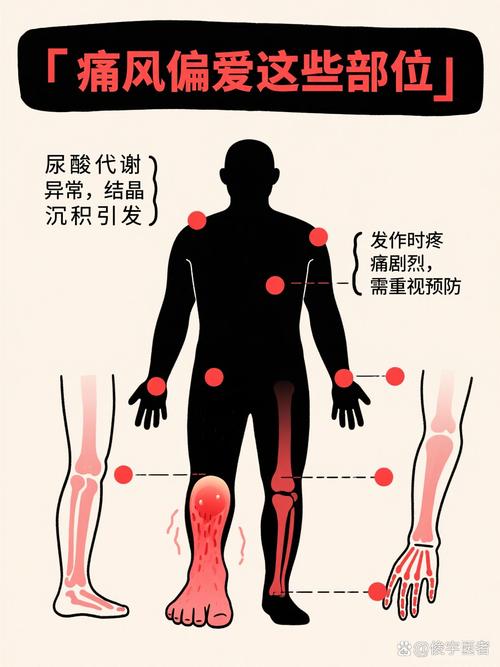 痛风为什么晚上特别痛