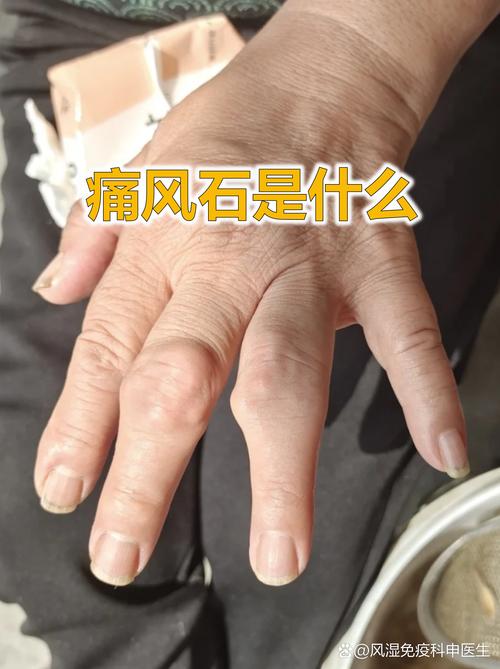 痛风一定会有痛风石吗