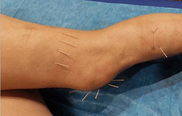 滑膜炎针灸几次见效