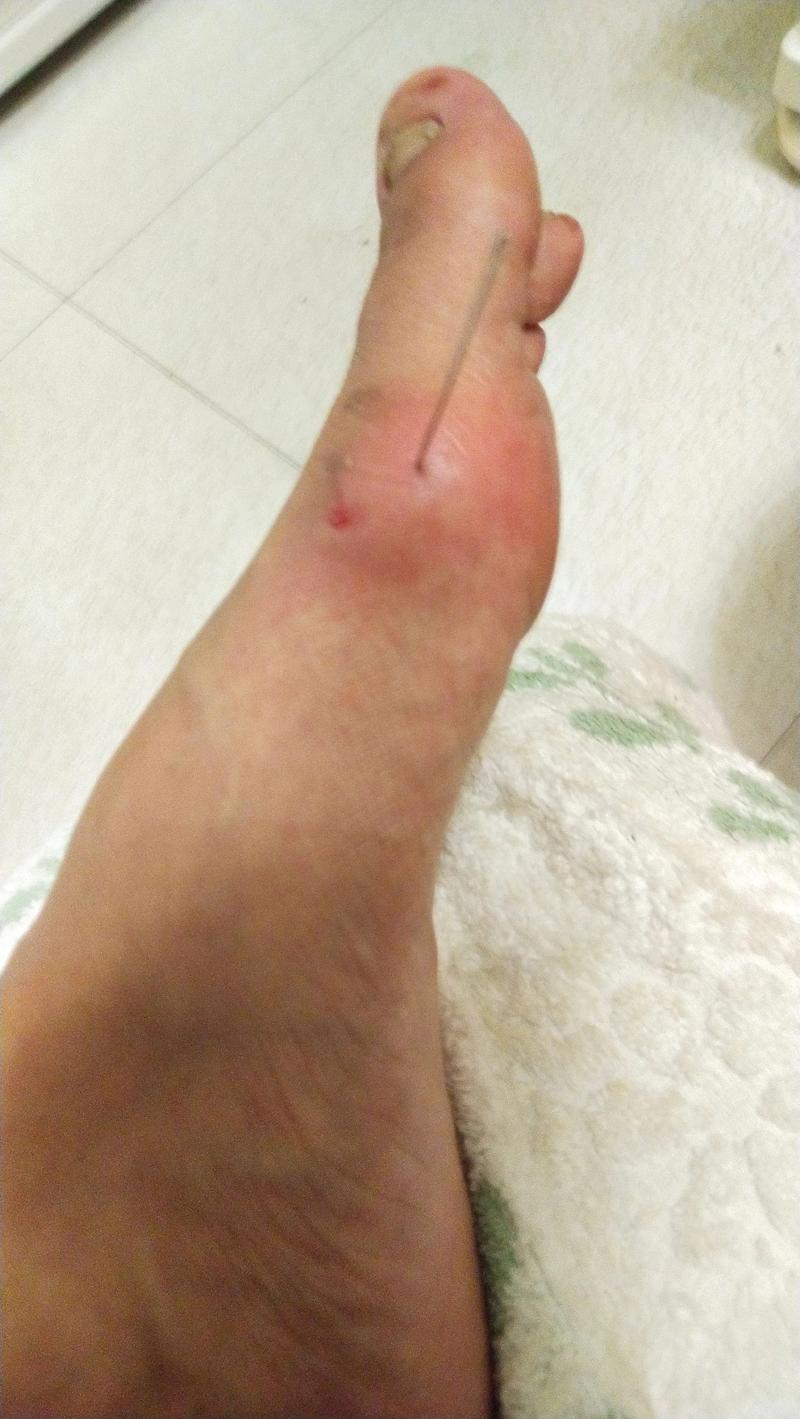 针灸可以治疗通风吗