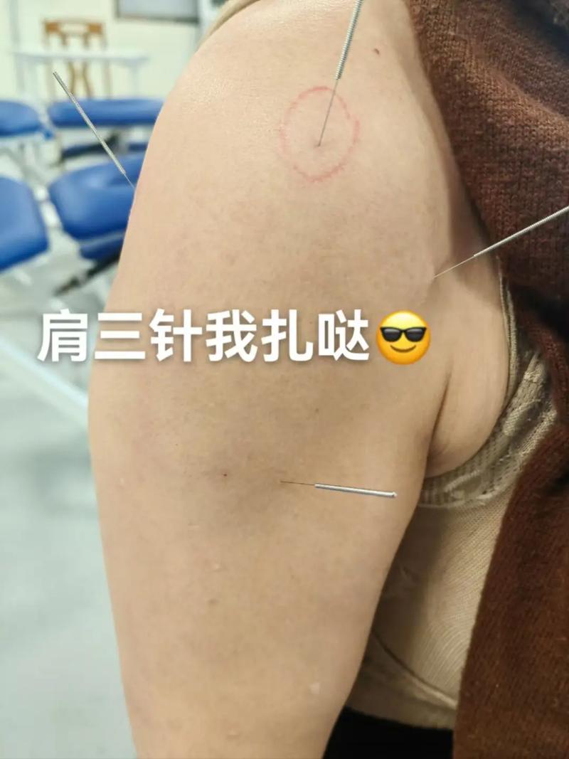 肩周炎针灸图的位置