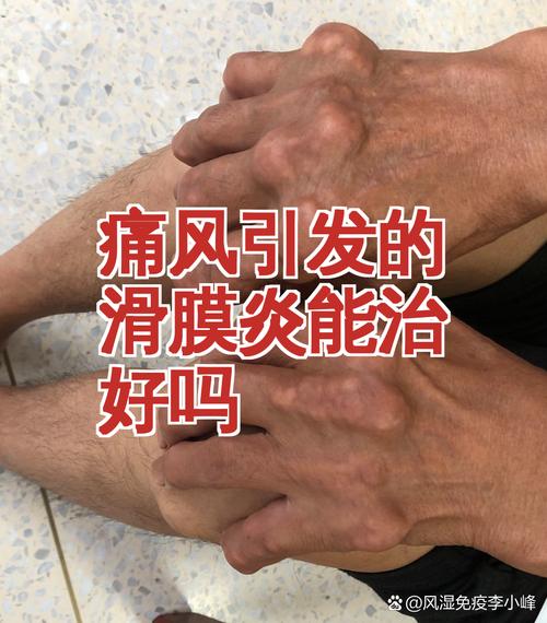 痛风性滑膜炎怎么治疗