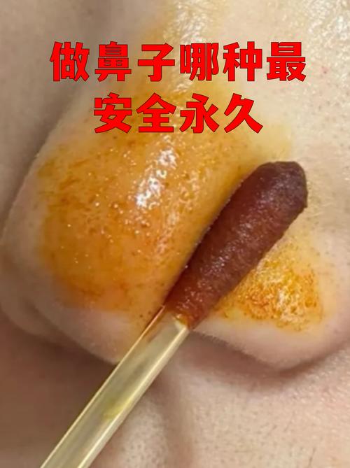永久隆鼻最安全的方法