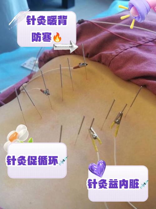 肌肉拉伤针灸管用吗