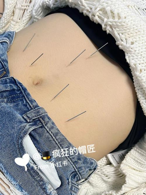 扎针灸能减肚子图片