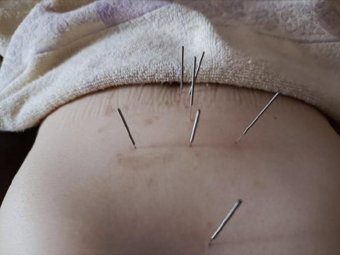 扎针灸能减肚子图片