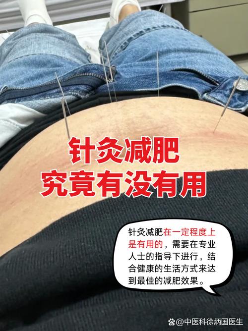 宿迁哪里有针灸减肥