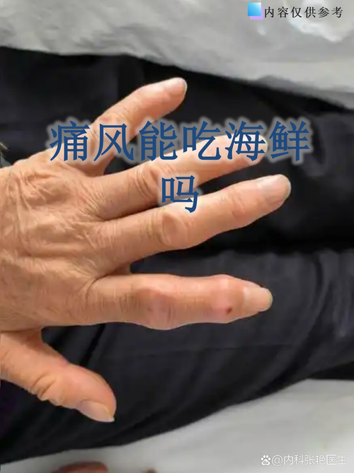 痛风可以吃深海鱼油吗