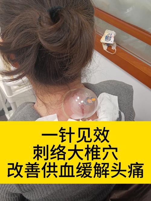 针灸大椎有什么效果