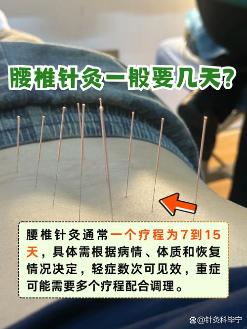 椎间盘突出针灸多久