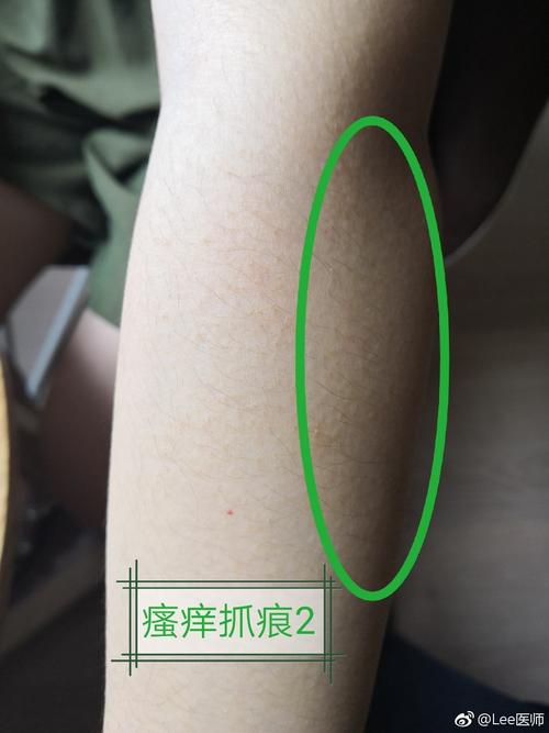 针灸周围发红 过敏