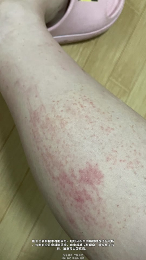 针灸周围发红 过敏