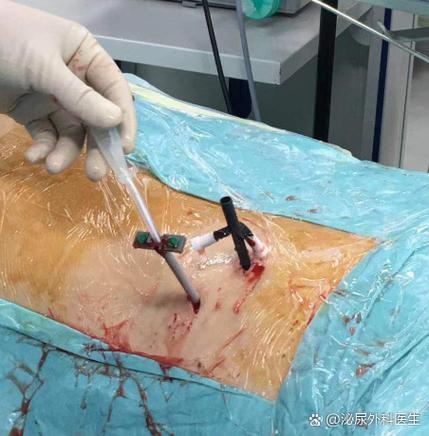 肾结石软管手术安全吗