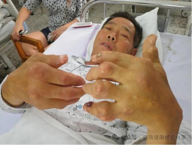 痛风严重会有什么后果