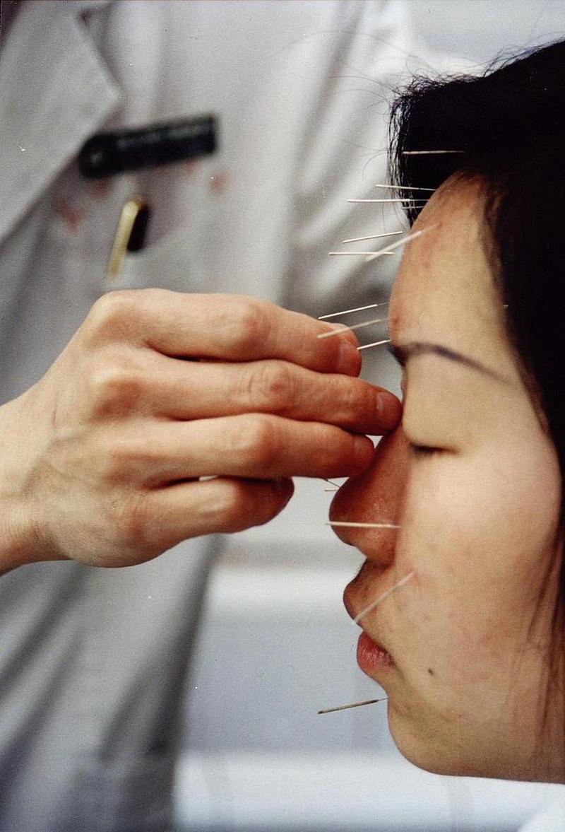 针灸 按摩治疗近视