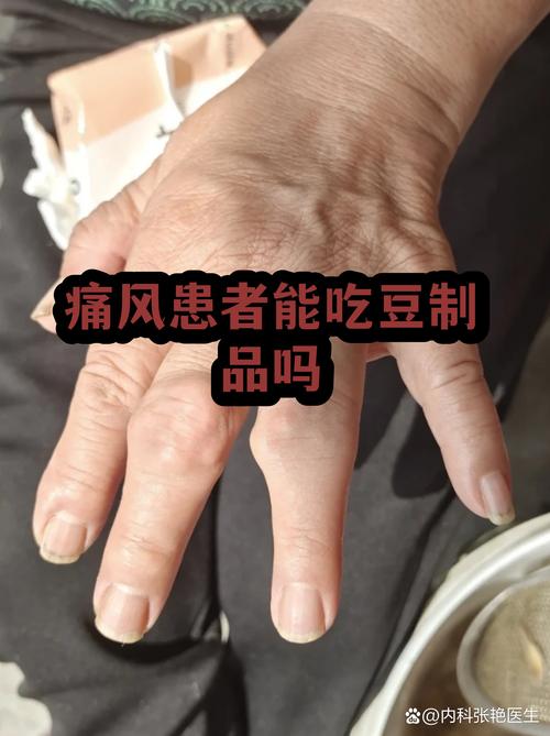 痛风患者可以吃豆腐吗