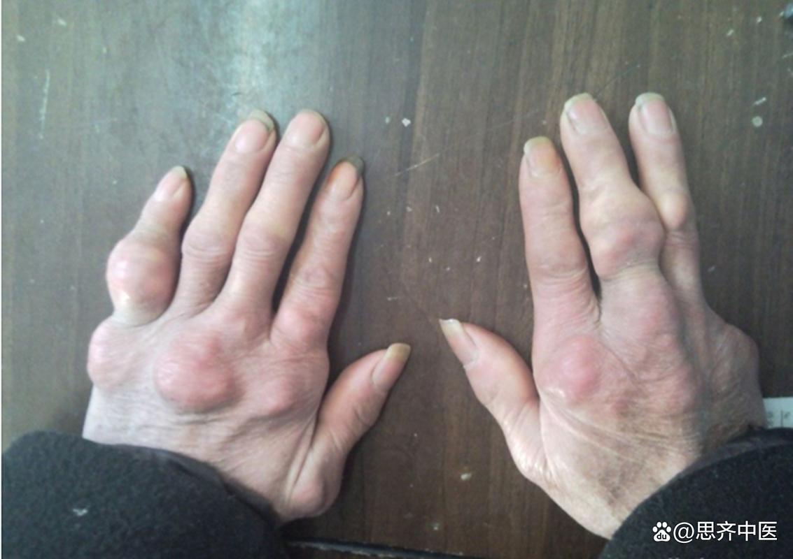 痛风石是硬的还是软的