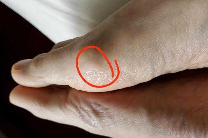 痛风石是硬的还是软的