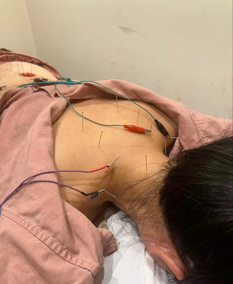 针灸治疗咽鼓管堵塞