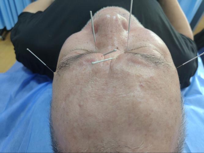 黄斑变性 针灸治疗