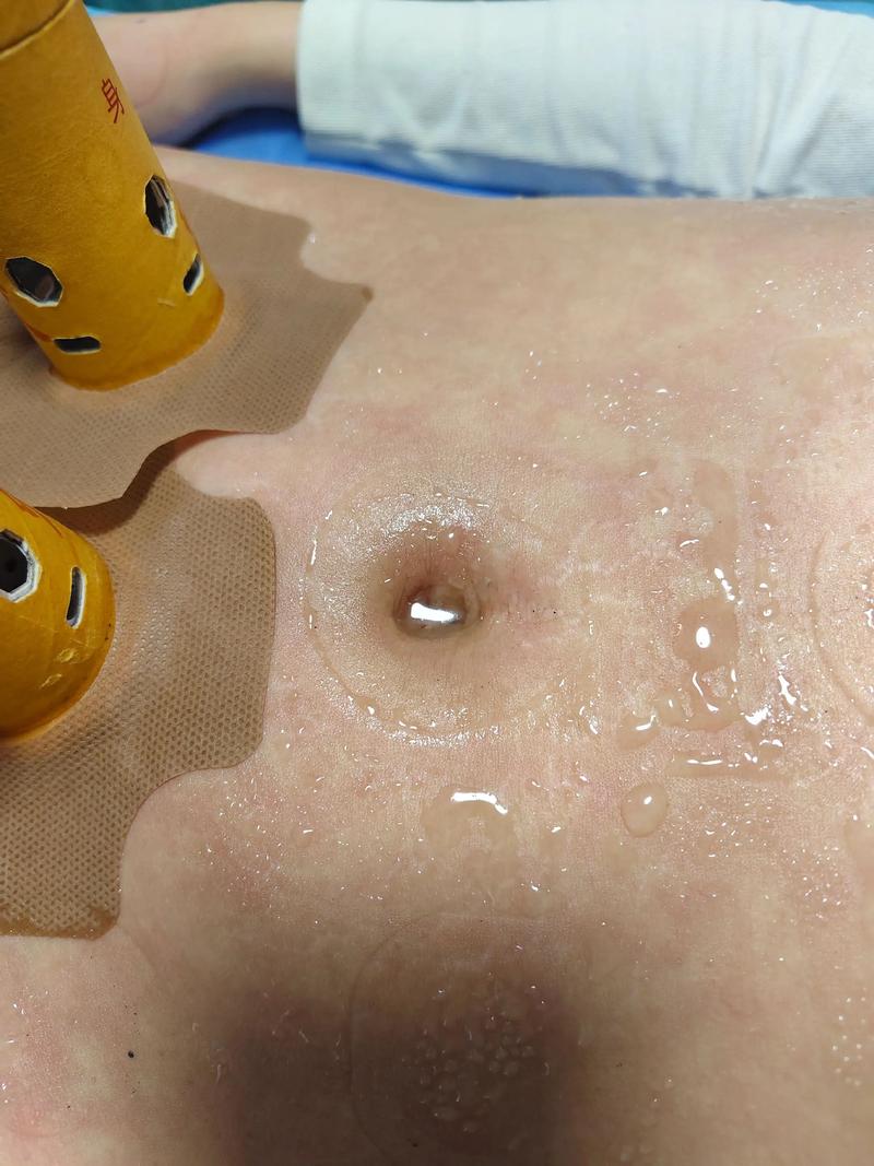 针灸减肥 下体流血