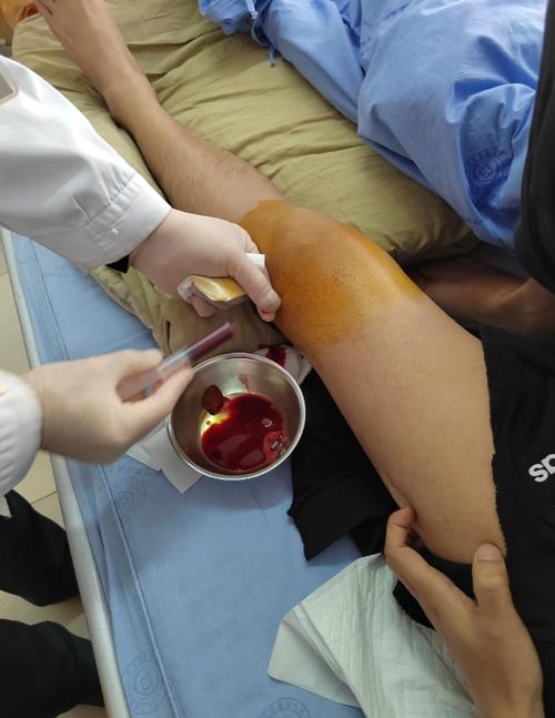 针灸减肥 下体流血