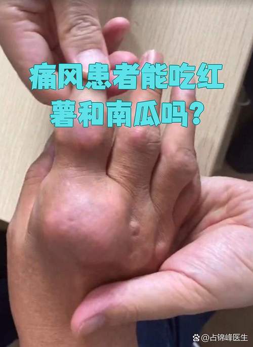 痛风病人可以吃南瓜吗